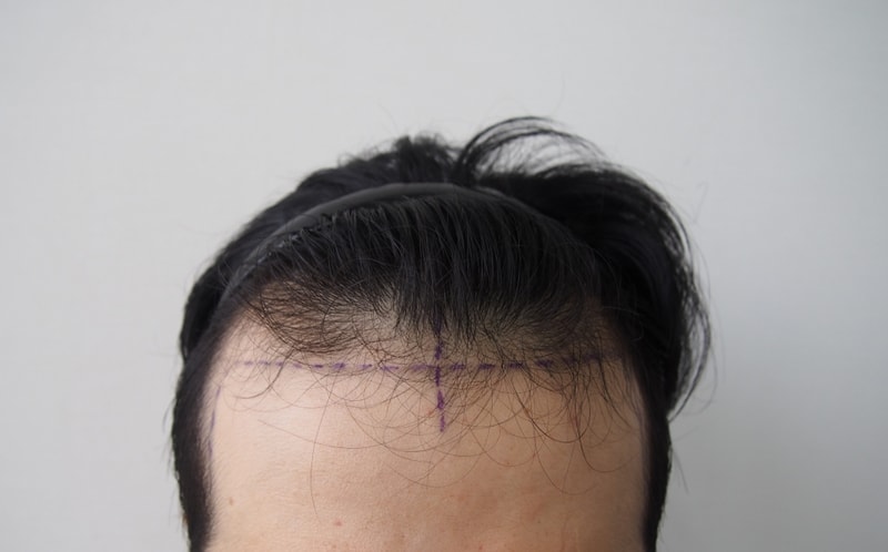 Immediately after the parent non-excision surgery