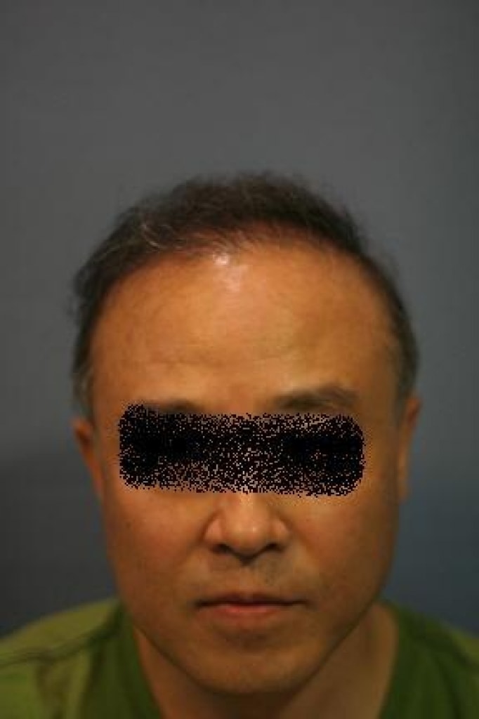 크기변환_6개월경과1.jpg