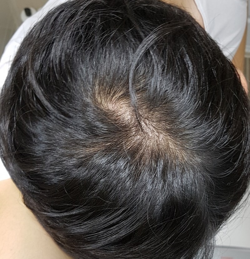 頭頂部移植5か月