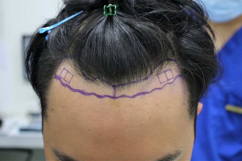I'm satisfied with the 10-month review of the m-shaped hair transplant