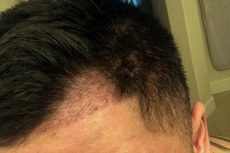 Working at a convenience store for 3 months and making money for hair transplantation___2 months