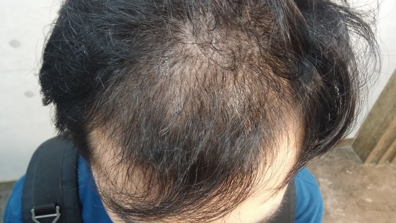 This is the end of the third day of incisional 4,792 hair transplantation.