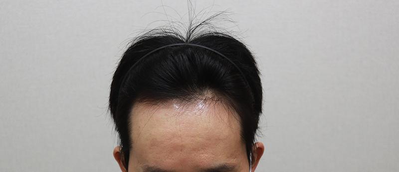 Mo Plus) This is the 13th month of hair transplantation.(This is the last review)