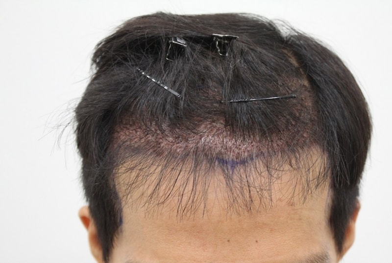 수술후.jpg