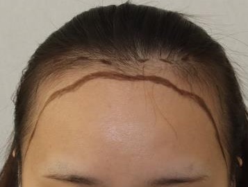 6th Month of Hair Transplantation Review