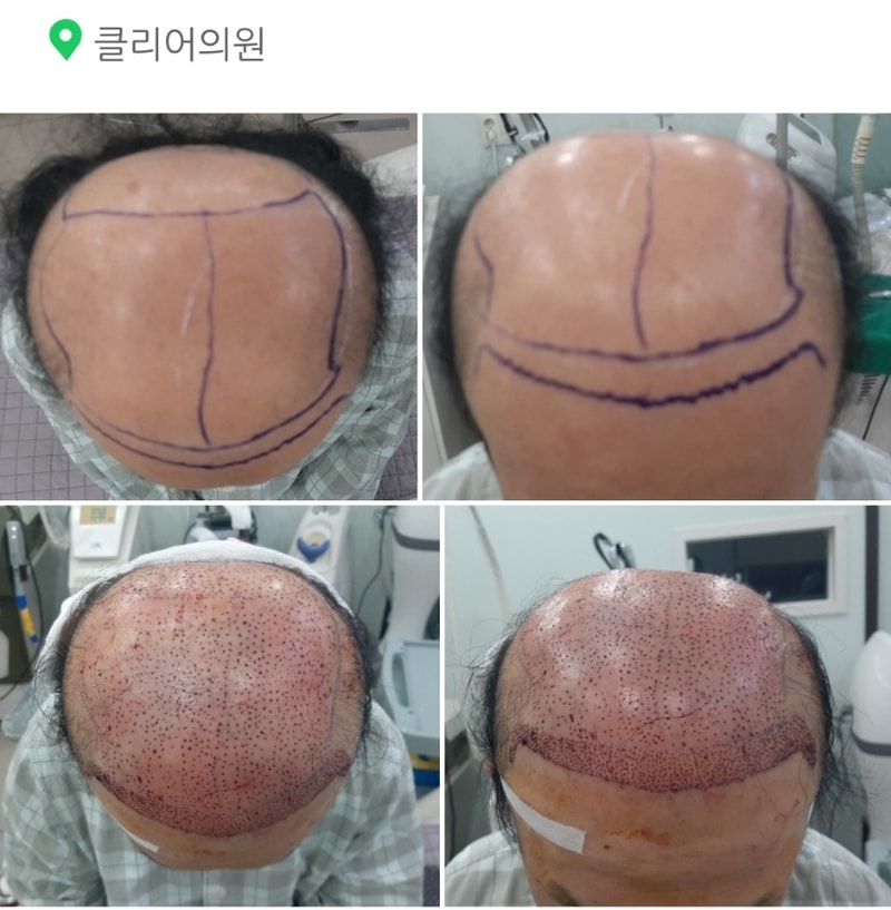 비절개 오늘날짜로 하루모자란 6개월째입니다~