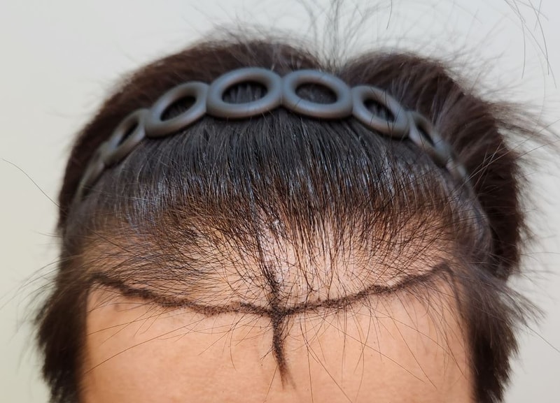 수술디자인.JPG