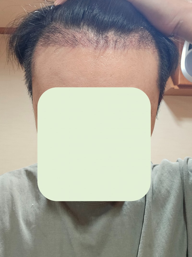 非切開1ヵ月目の後記