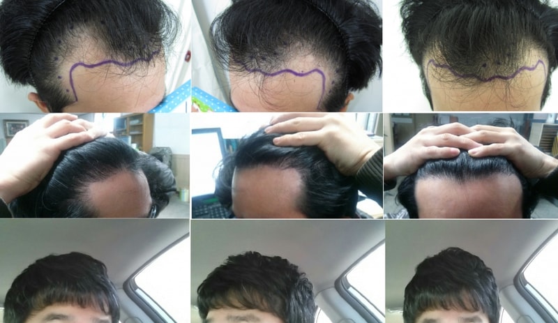 이식후진행.jpg