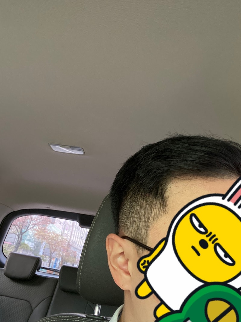 모발이식한지 3년 10개월 지났네요