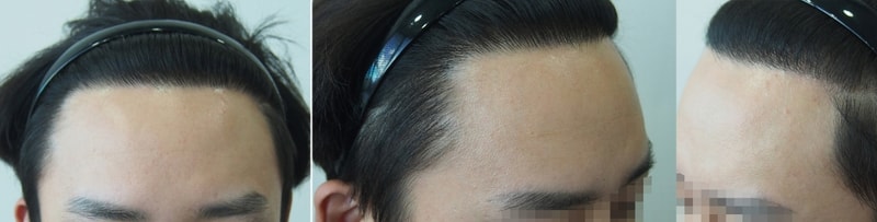 I got my second hair transplant