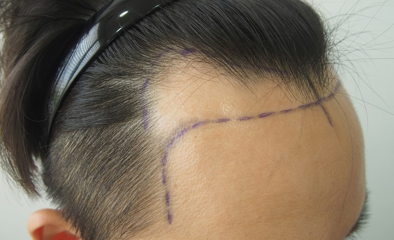 I implanted Cheom's hairPost photos and reviews immediately.