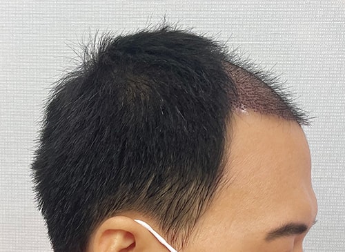 수술1일차02.jpg
