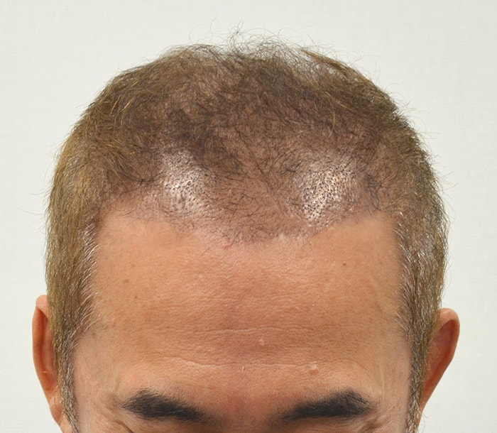 수술후 2주차.jpg