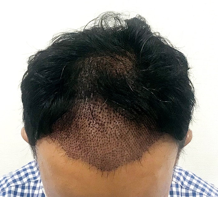 수술 1일차.jpg