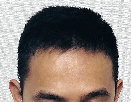 수술 후.jpg