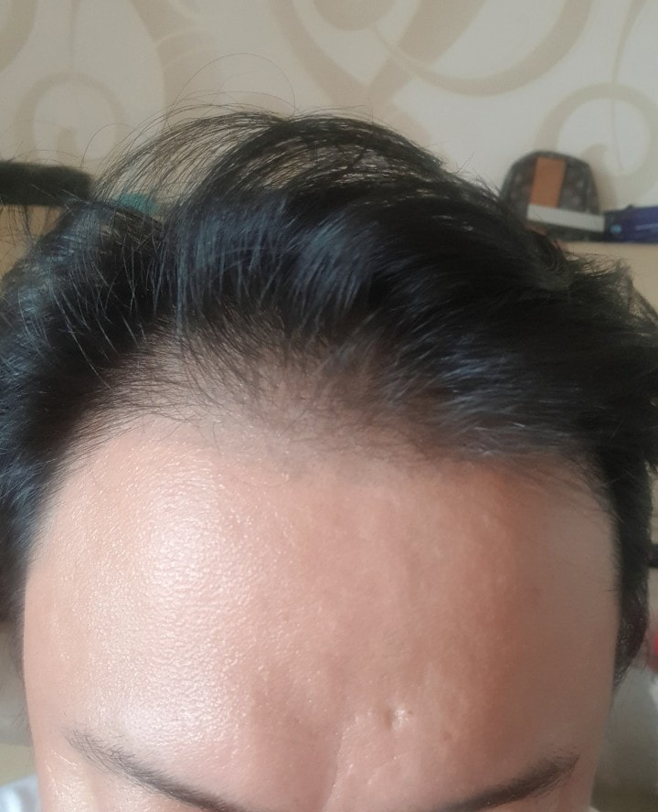 수술전.jpg