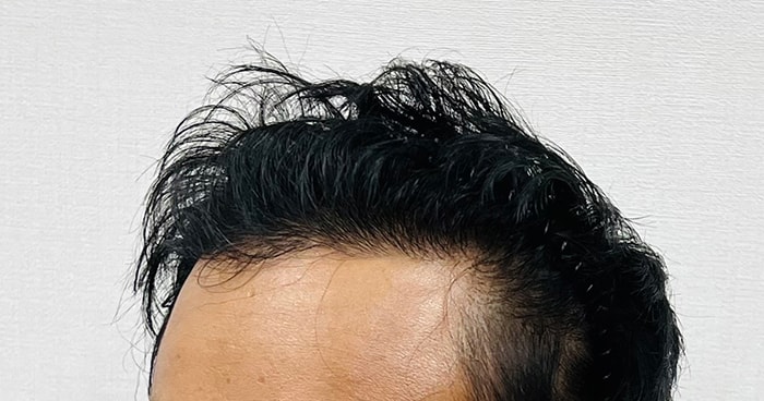 수술후12개월차.jpg