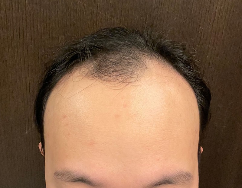라비앙에서 수술하고 성형미남 여친한테 인정받았습니다