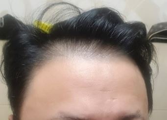 수술전.JPG