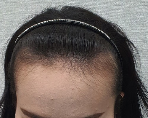 수술전.jpg