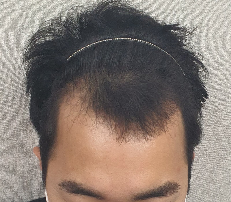수술전.jpg