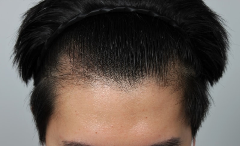 First Year Review of Hair Transplantation at Busan Branch of Forehead