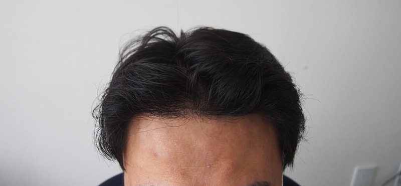 비절개 15개월차 경과 사진 입니다