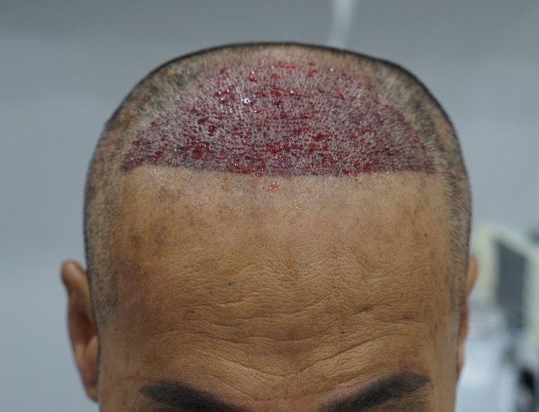 It is the 14th day of the non-cut 3500 hair secondary hair transplant at The Beauty Plastic Surgery.