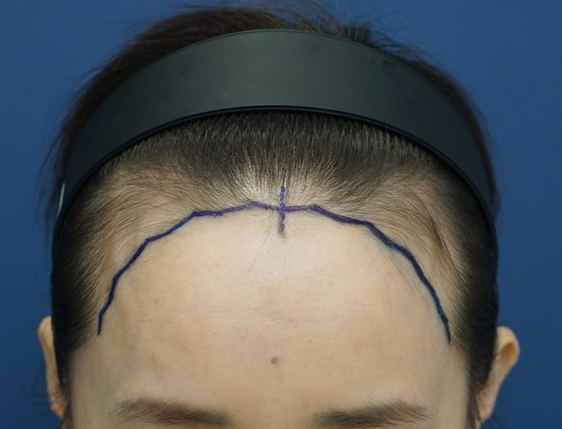 ★더뷰티 모발이식★ 헤어라인 교정 절개 2700모 4개월 접어든 후기