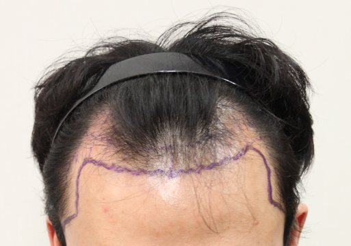 It's a review of non-intersected 2465 hair follicles in the 7th month