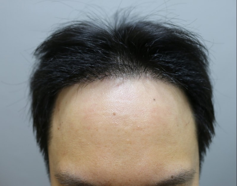 4개월경과-1.jpg