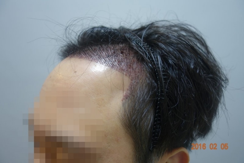 수술다음날-2.jpg