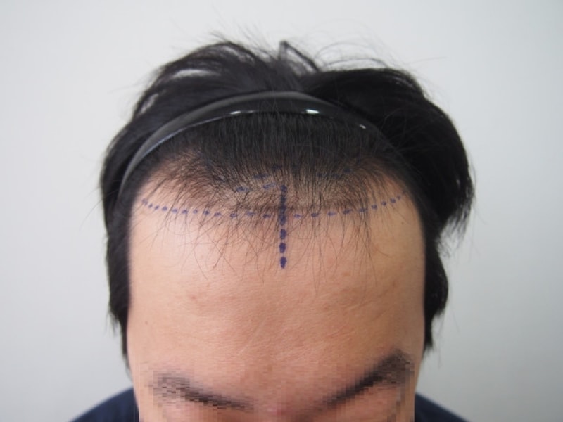 鼻切開1300毛包の手術1日目です。