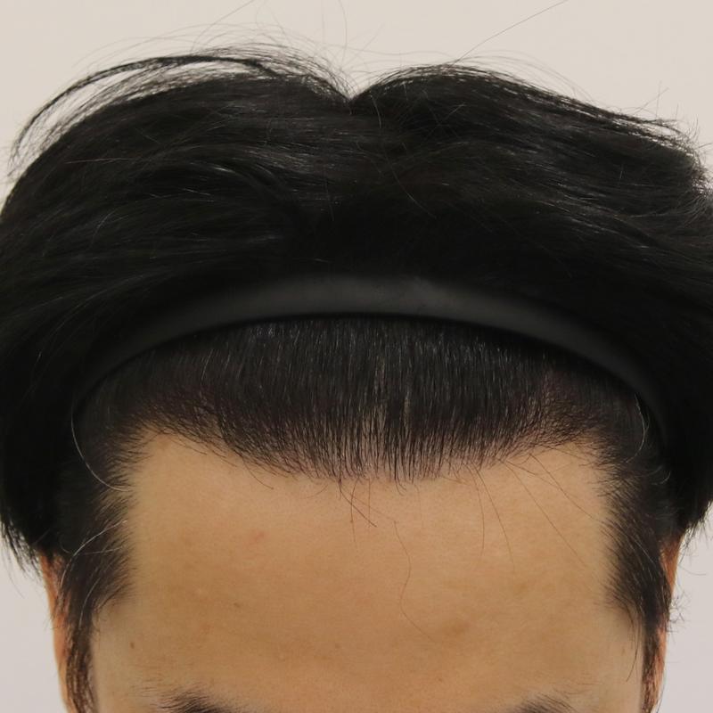 부산모발이식 M자 비절개 2주 경과! [맘모스헤어라인]