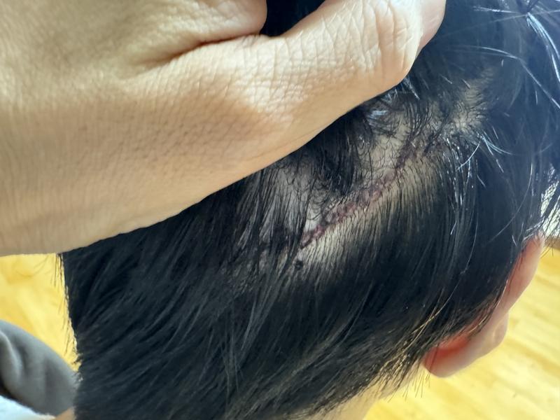 New Hair Seoul branch incision hair transplant 1800 hair follicles(3,600 hair) This is the third day of surgery