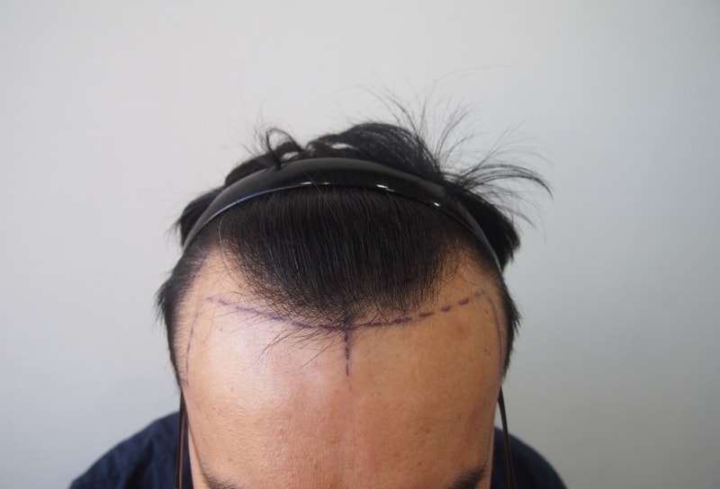 이식전.jpg