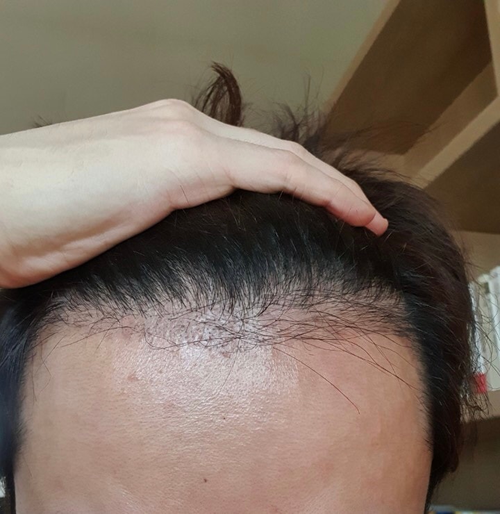 다나 절개 재수술 3달