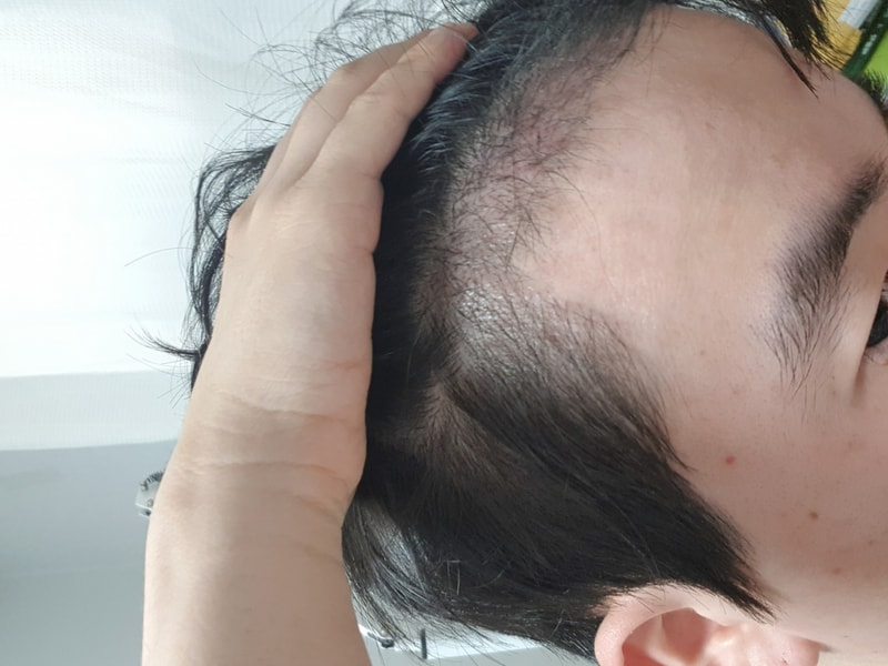 [NHI뉴헤어] [NHI뉴헤어] (절개 - 1700모낭 ) 100일차