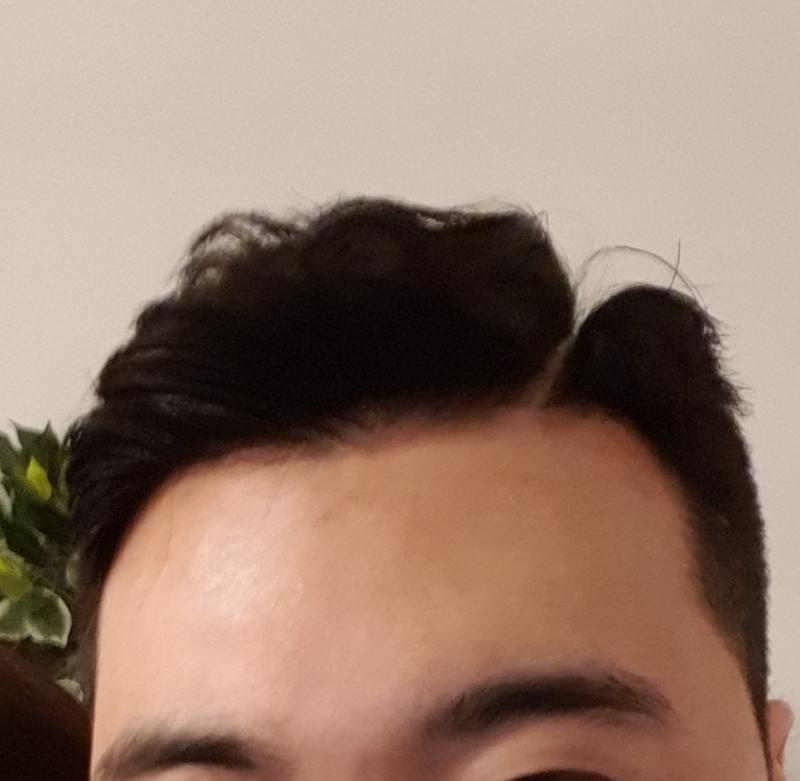 M자 극복기 (비절개 1년차 후기)