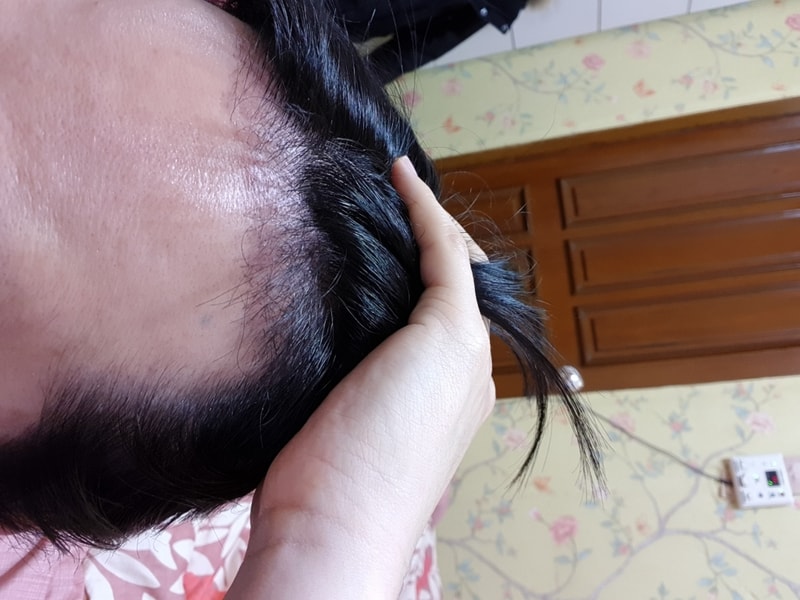 I'm in the third month of a new hair incision