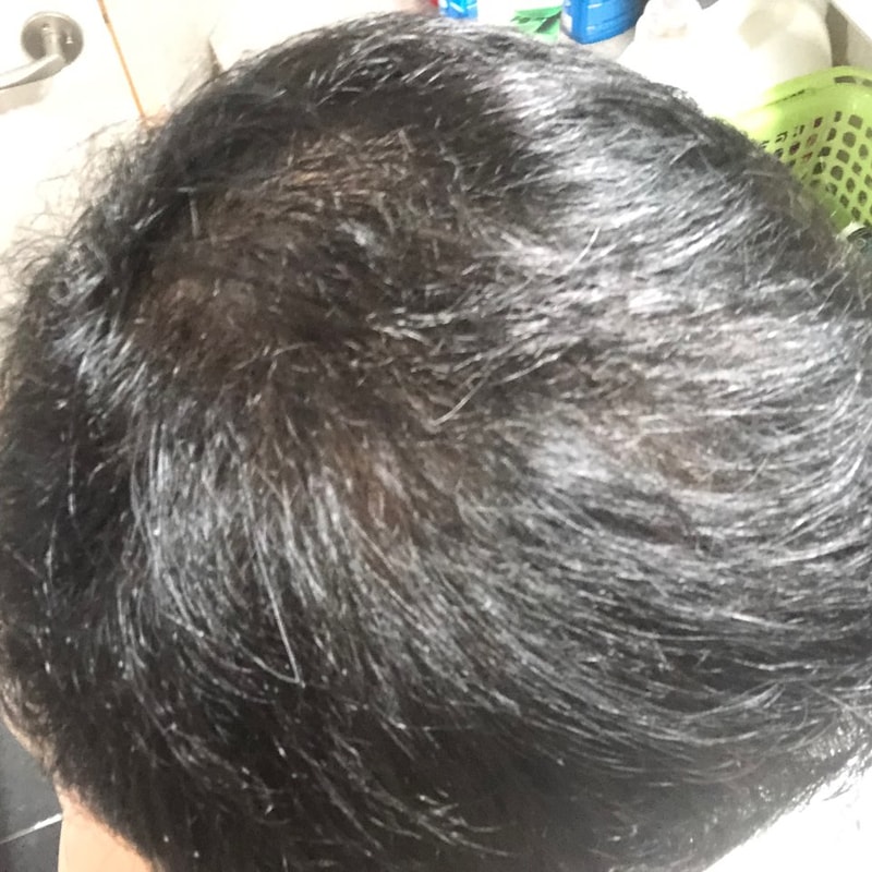 정수리 이식 8개월 사진 구경하세요