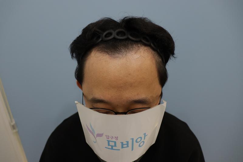 광주 압구정모비앙 모발이식 10개월 경과 후기