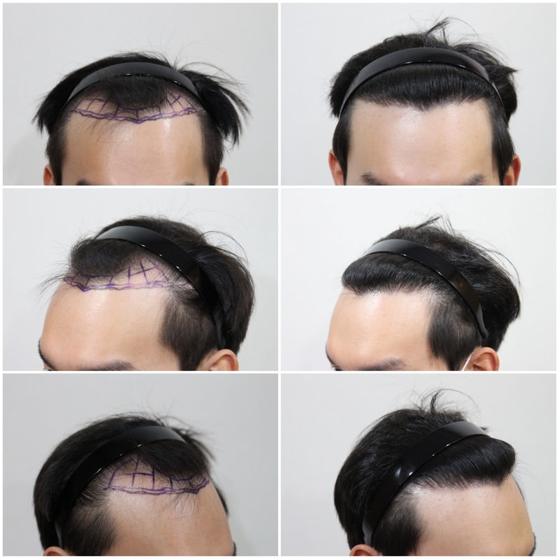 Here's a photo of the post-mortem after a year of incision 3000 Mo!