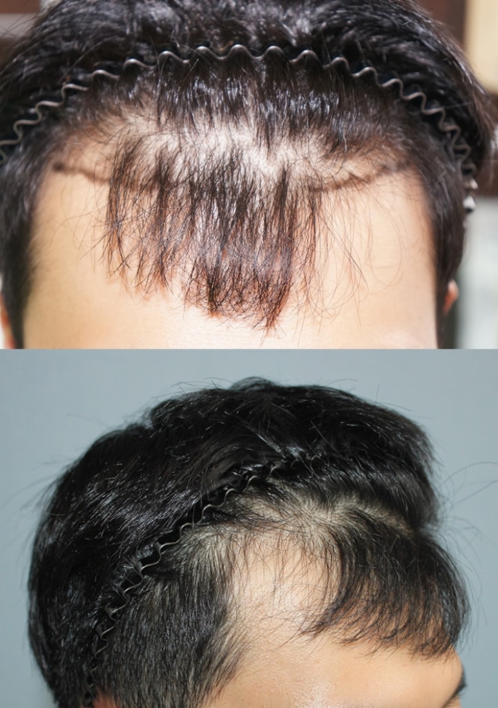 Non-cutaneous Hair Transplantation 2200 Mo 4th Year Review