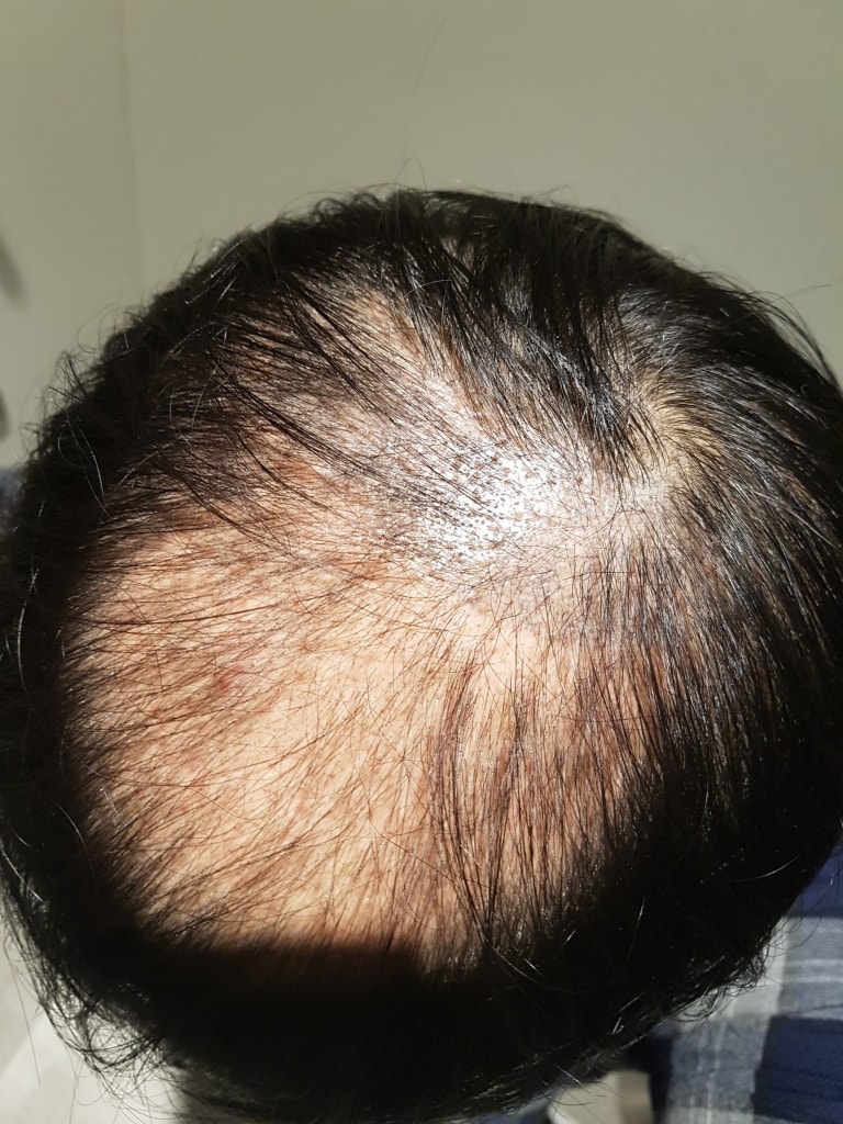 毛发移植1个月后期。