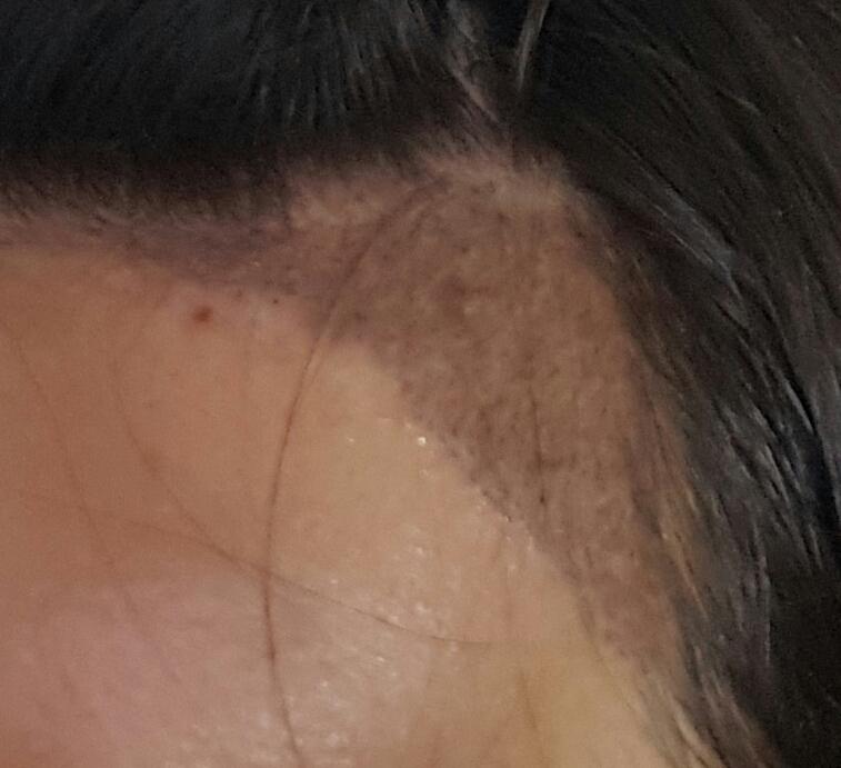 ジェンマ、ヘアライン矯正後のレビュー