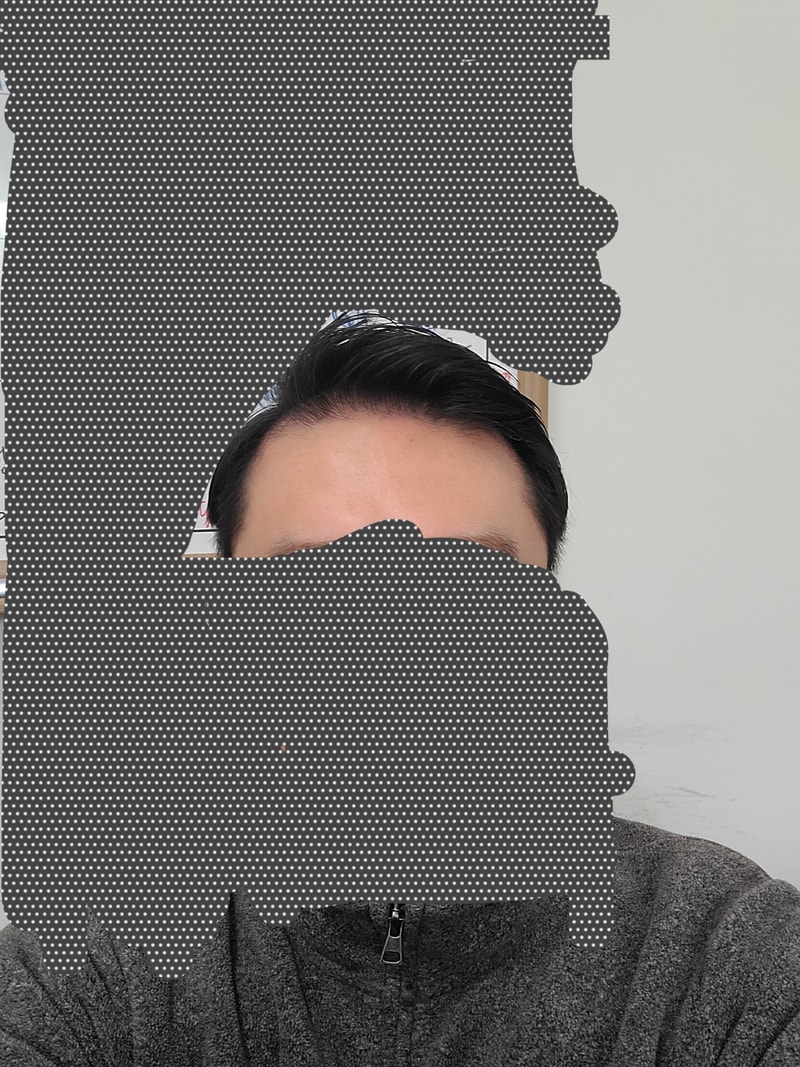 剃光头手术才1个月，哇...哈哈哈