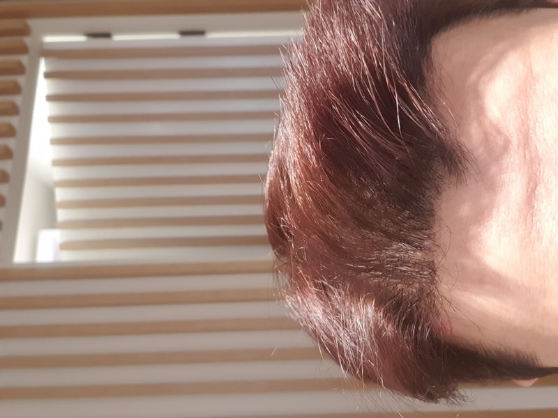 모디헤어플란트 9개월 경과입니다