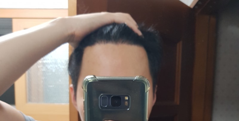 12 month progress photo